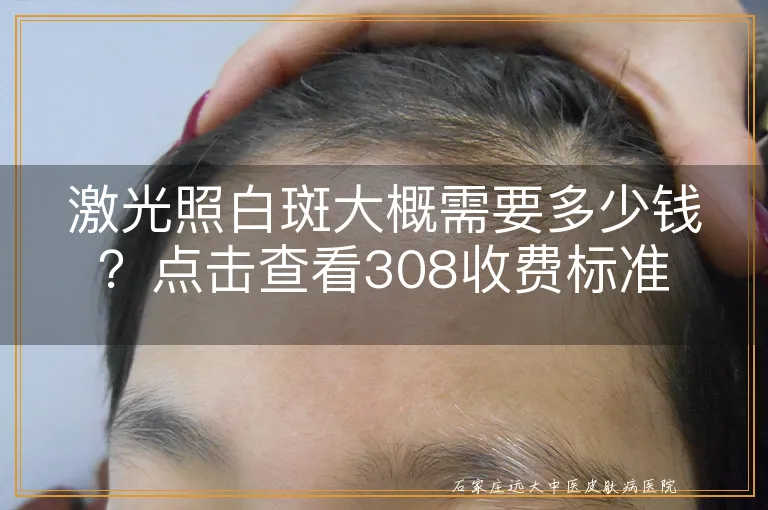 激光照白斑大概需要多少钱？点击查看308收费标准