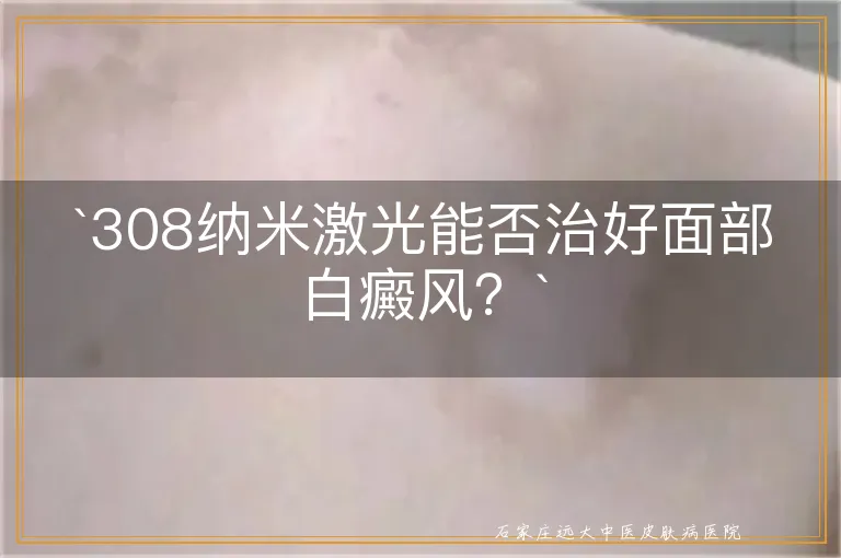 `308纳米激光能否治好面部白癜风？`