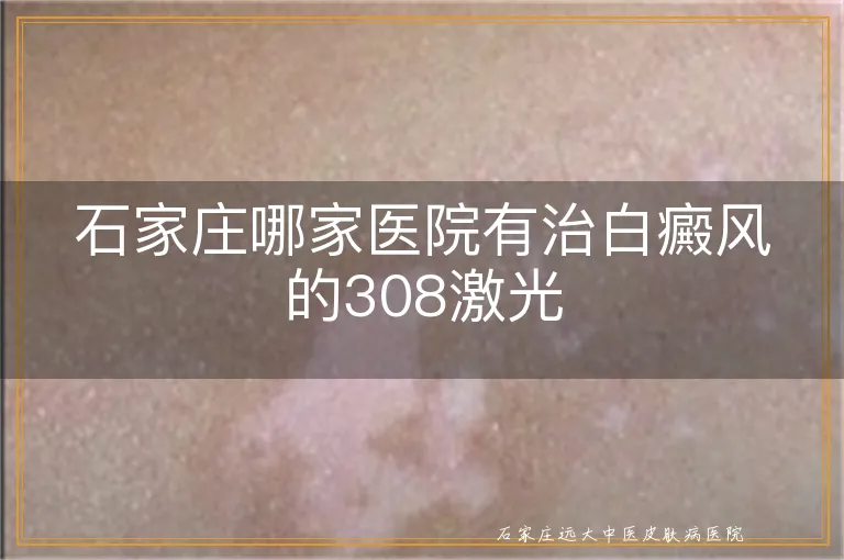 石家庄哪家医院有治白癜风的308激光