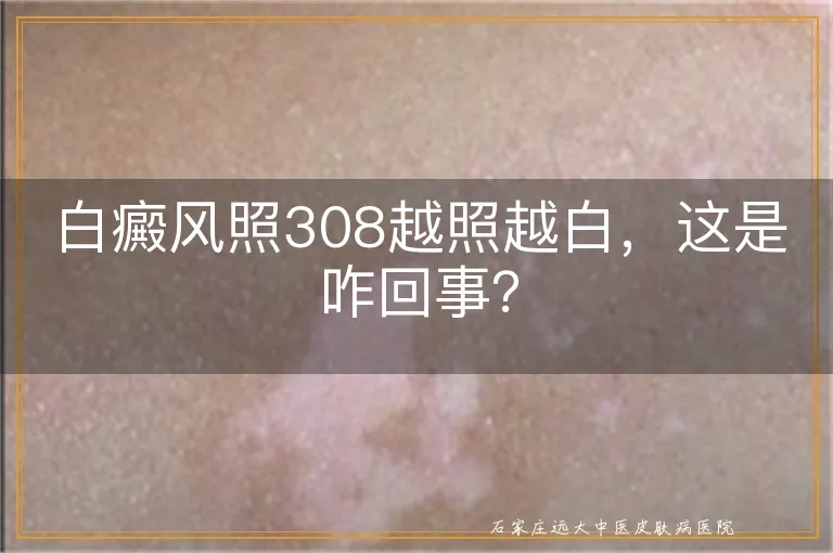 白癜风照308越照越白，这是咋回事？