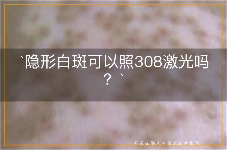 隐形白斑可以照308激光吗？