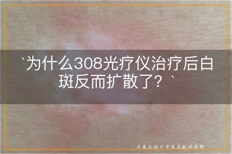 为什么308光疗仪治疗后白斑反而扩散了？