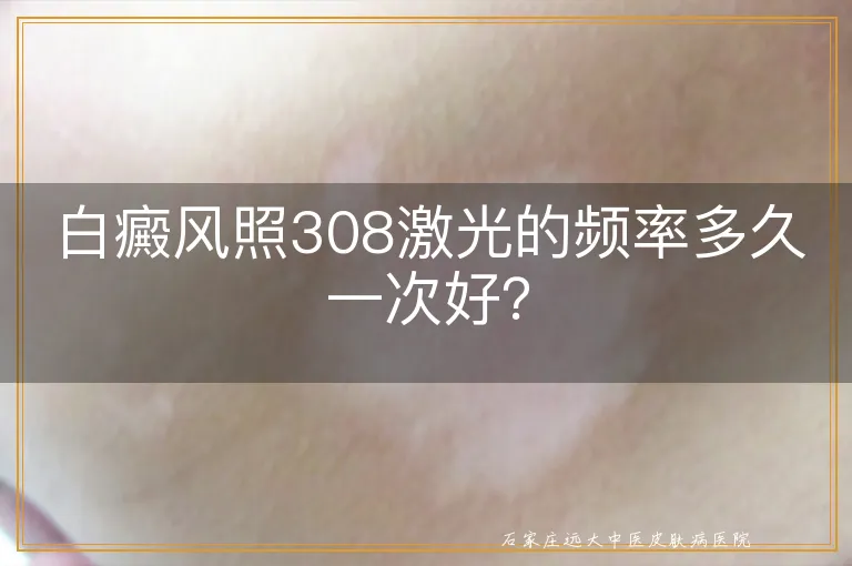 白癜风照308激光的频率多久一次好？