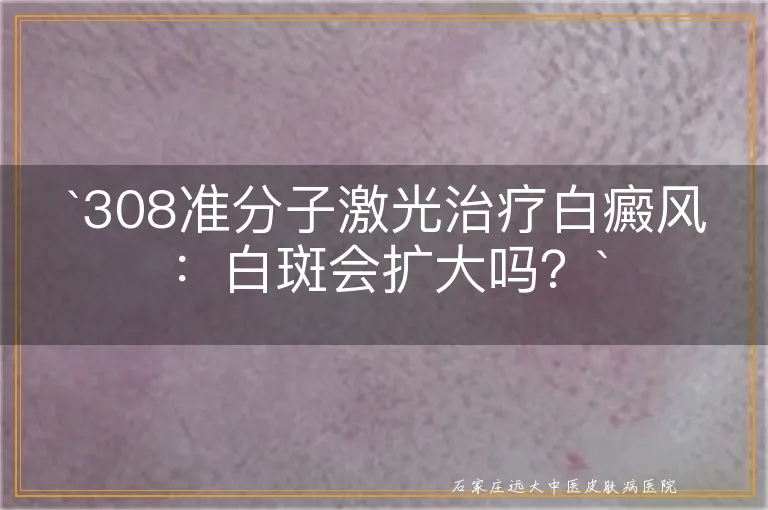 `308准分子激光治疗白癜风：白斑会扩大吗？`