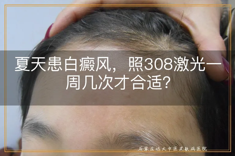 夏天患白癜风，照308激光一周几次才合适？