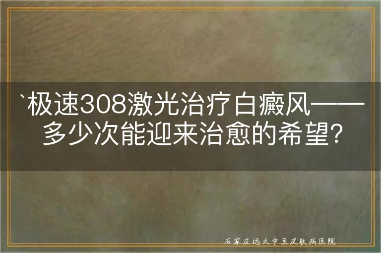 极速308激光治疗白癜风——多少次能迎来治愈的希望？