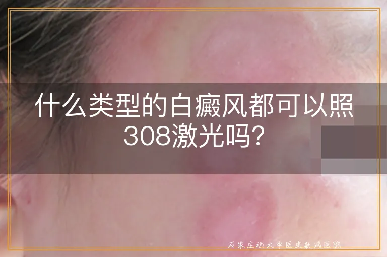 什么类型的白癜风都可以照308激光吗？