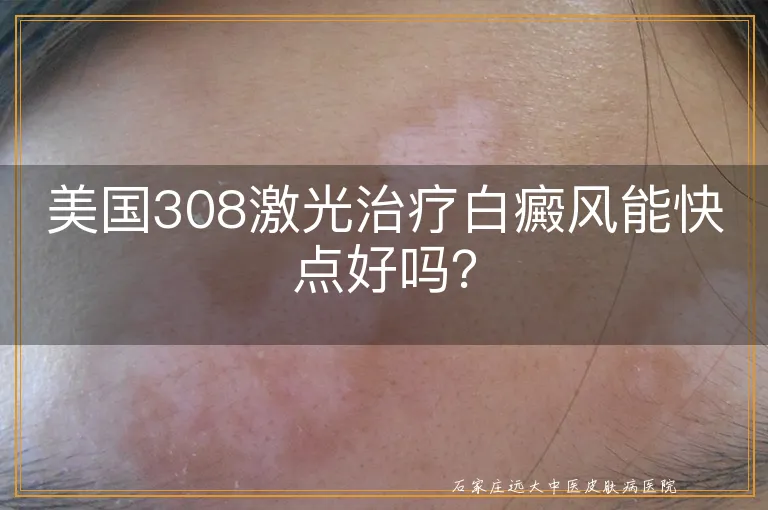 美国308激光治疗白癜风能快点好吗？