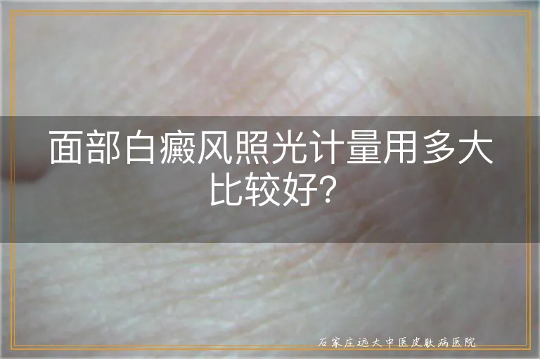 面部白癜风照光计量用多大比较好？