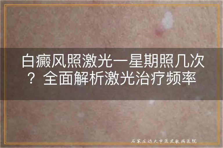 白癜风照激光一星期照几次？全面解析激光治疗频率