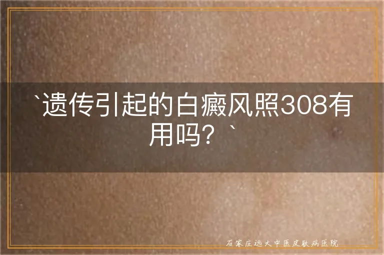 `遗传引起的白癜风照308有用吗？`