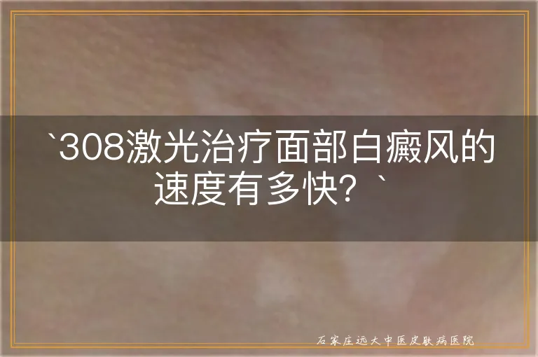 308激光治疗面部白癜风的速度有多快？