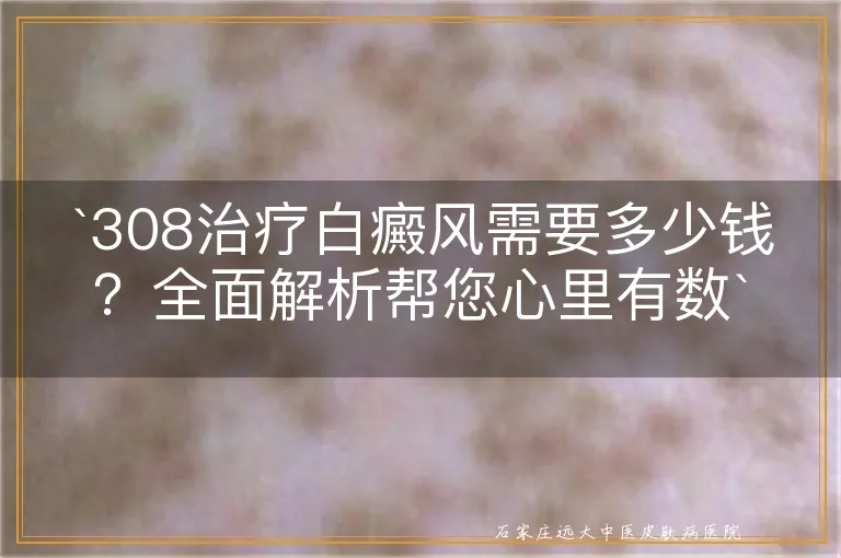 `308治疗白癜风需要多少钱？全面解析帮您心里有数`