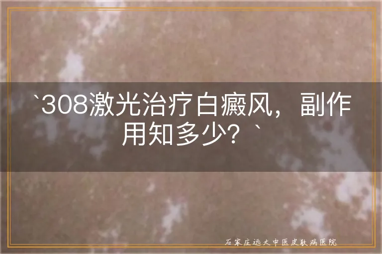 `308激光治疗白癜风，副作用知多少？`