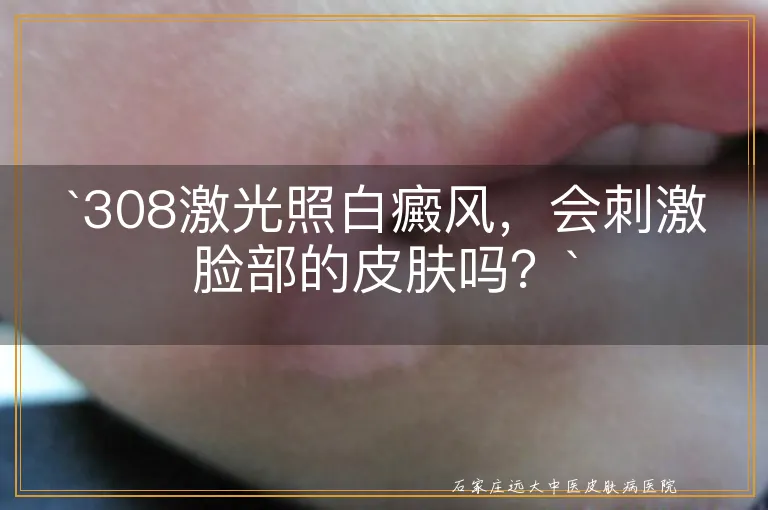 `308激光照白癜风，会刺激脸部的皮肤吗？`