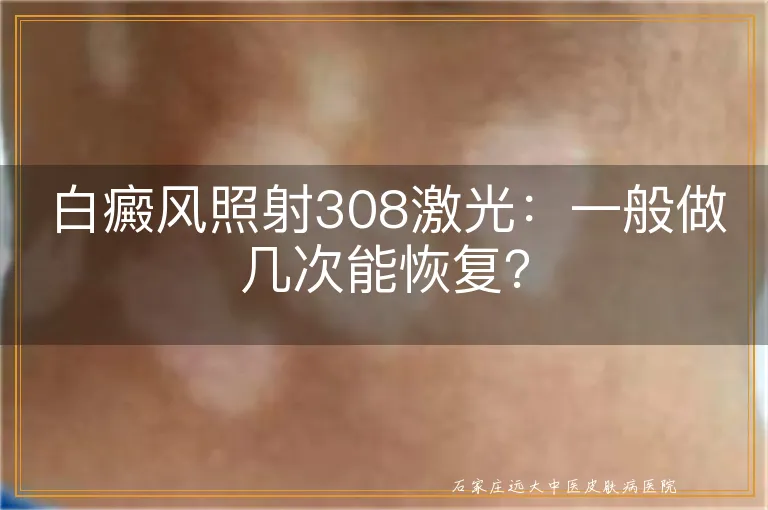 白癜风照射308激光：一般做几次能恢复？