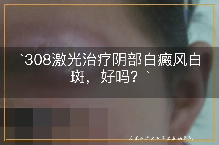 `308激光治疗阴部白癜风白斑，好吗？`