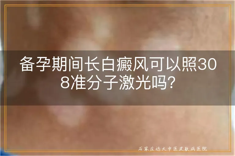 备孕期间长白癜风可以照308准分子激光吗？