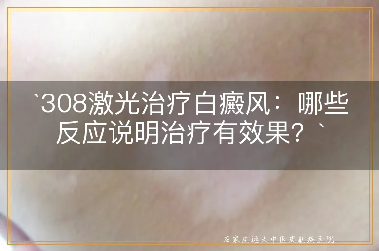 `308激光治疗白癜风：哪些反应说明治疗有效果？`