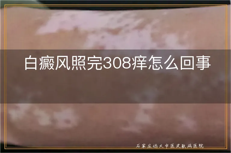 白癜风照完308痒怎么回事