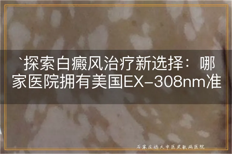 `探索白癜风治疗新选择：哪家医院拥有美国EX-308nm准分子激光治疗系统`