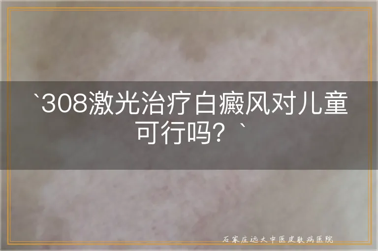 `308激光治疗白癜风对儿童可行吗？`