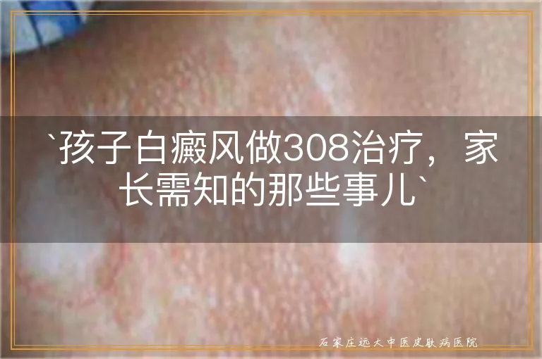 `孩子白癜风做308治疗，家长需知的那些事儿`