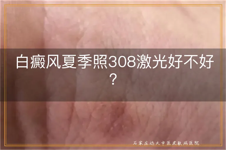 白癜风夏季照308激光好不好？