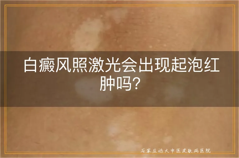 白癜风照激光会出现起泡红肿吗？