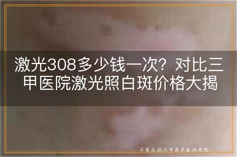 激光308多少钱一次？对比三甲医院激光照白斑价格大揭秘