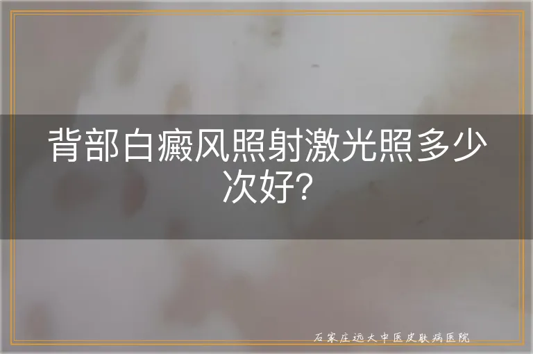 背部白癜风照射激光照多少次好？