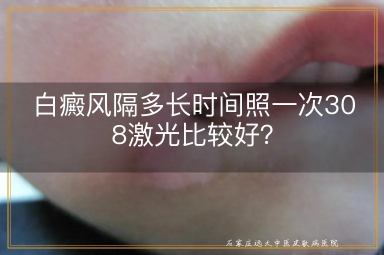 白癜风隔多长时间照一次308激光比较好？