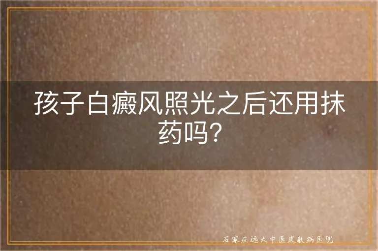 孩子白癜风照光之后还用抹药吗？