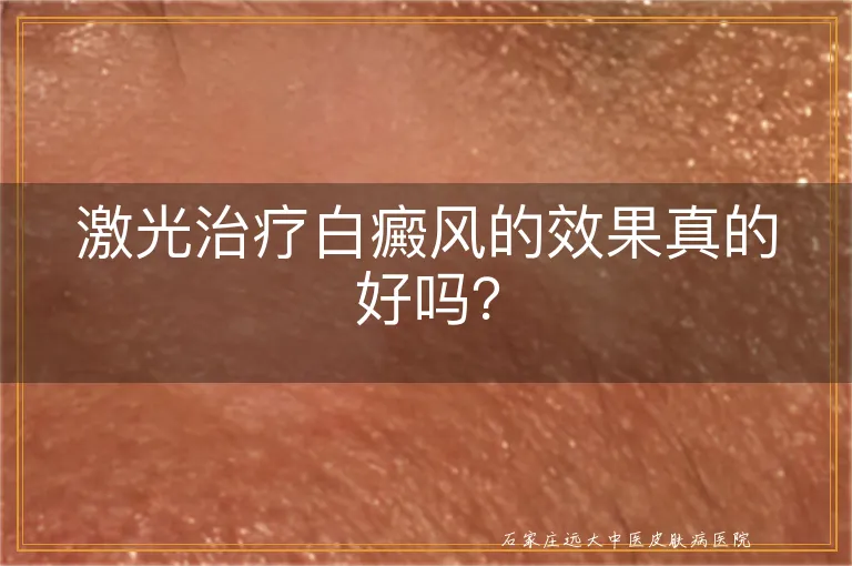 激光治疗白癜风的效果真的好吗？