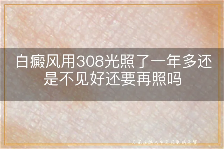 白癜风用308光照了一年多还是不见好还要再照吗