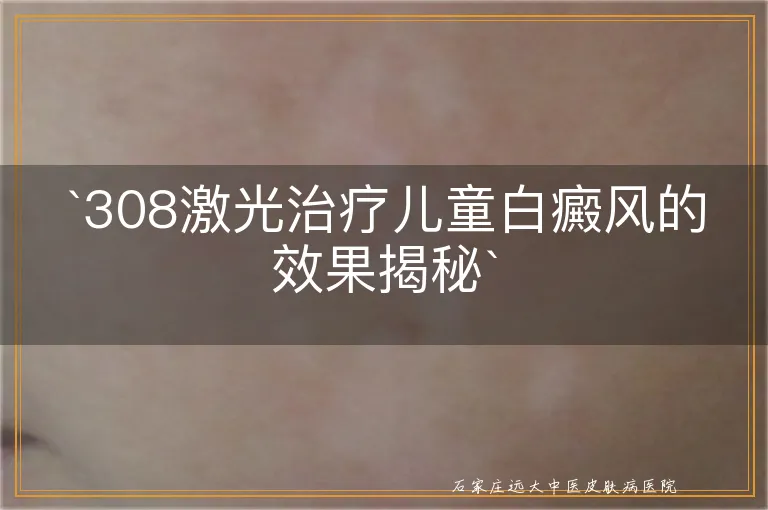 `308激光治疗儿童白癜风的效果揭秘`