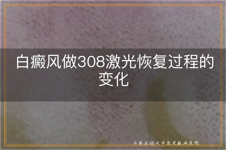 白癜风做308激光恢复过程的变化