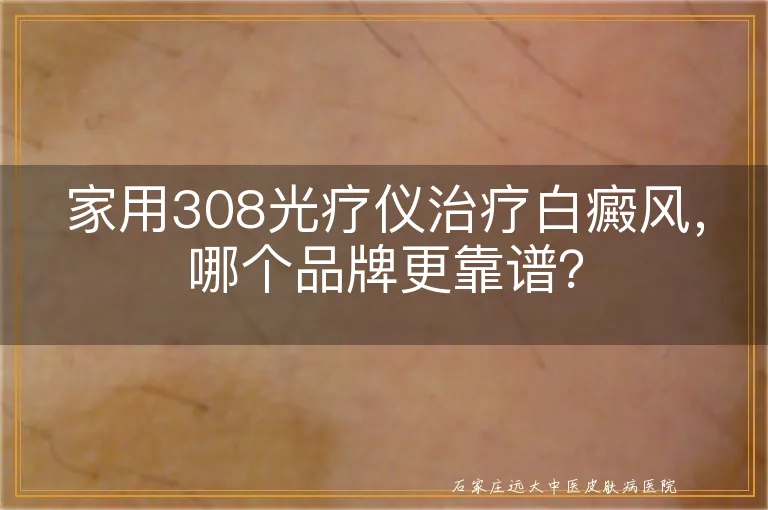 家用308光疗仪治疗白癜风，哪个品牌更靠谱？