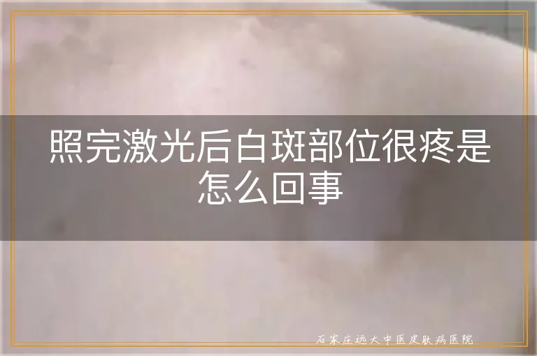 照完激光后白斑部位很疼是怎么回事