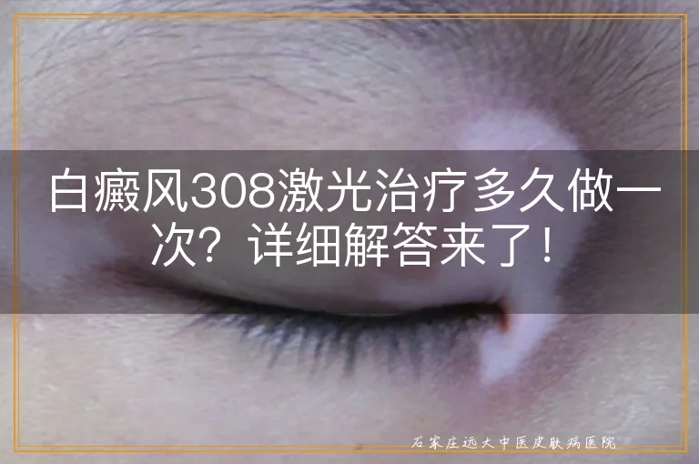 白癜风308激光治疗多久做一次？详细解答来了！