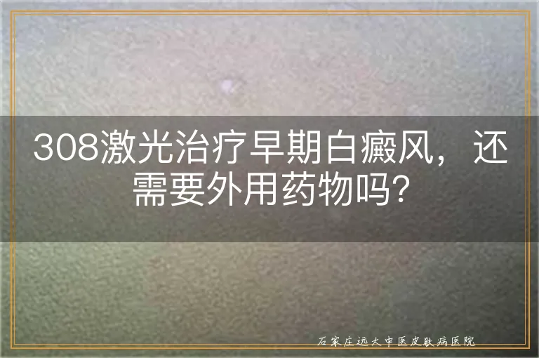 308激光治疗早期白癜风，还需要外用药物吗？