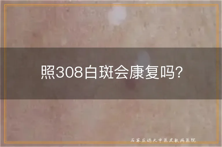 照308白斑会康复吗？