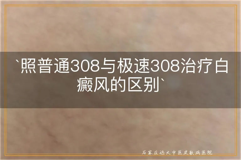 照普通308与极速308治疗白癜风的区别