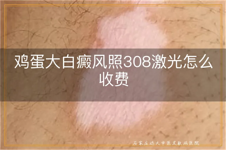 鸡蛋大白癜风照308激光怎么收费