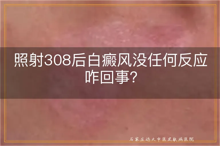 照射308后白癜风没任何反应咋回事？