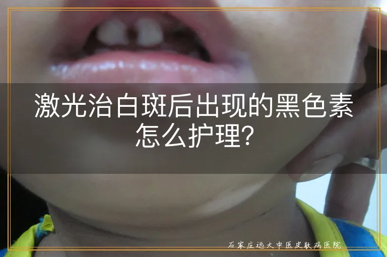 激光治白斑后出现的黑色素怎么护理？