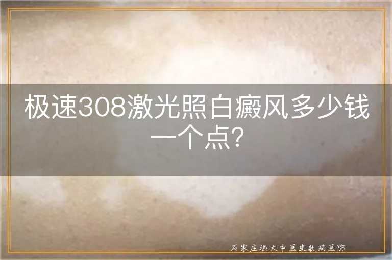 极速308激光照白癜风多少钱一个点？