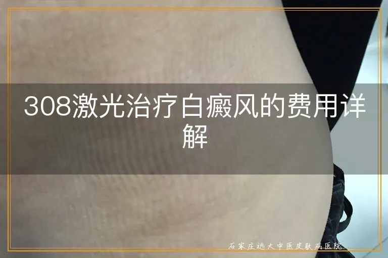 308激光治疗白癜风的费用详解