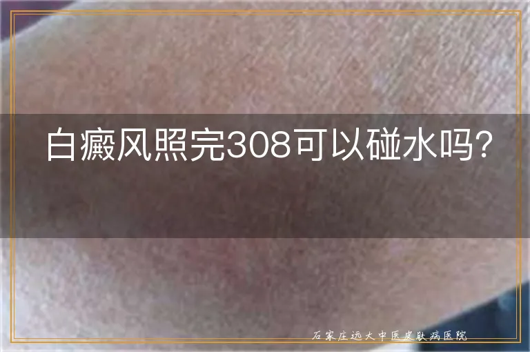 白癜风照完308可以碰水吗？