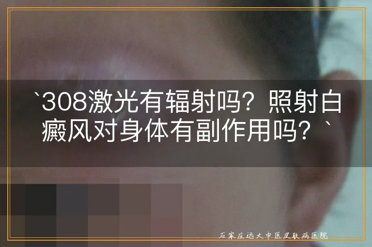 `308激光有辐射吗？照射白癜风对身体有副作用吗？`